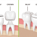 Need Crowns? See How Our Dental Clinic near Annerley Can Help