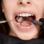 The Complete Guide to Fissure Sealants: Shielding Your Smile from Decay