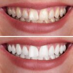 Picture-Perfect Teeth Whitening in Yeronga