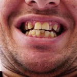 Should I be concerned about crooked teeth?
